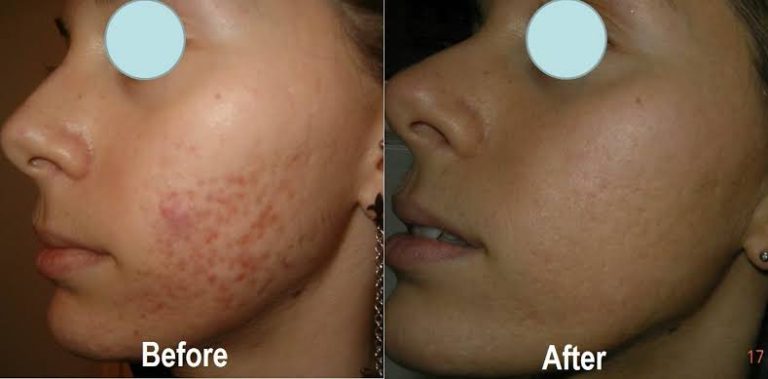 How Effective Are Salicylic Acid Peels for Acne Prone Skin?